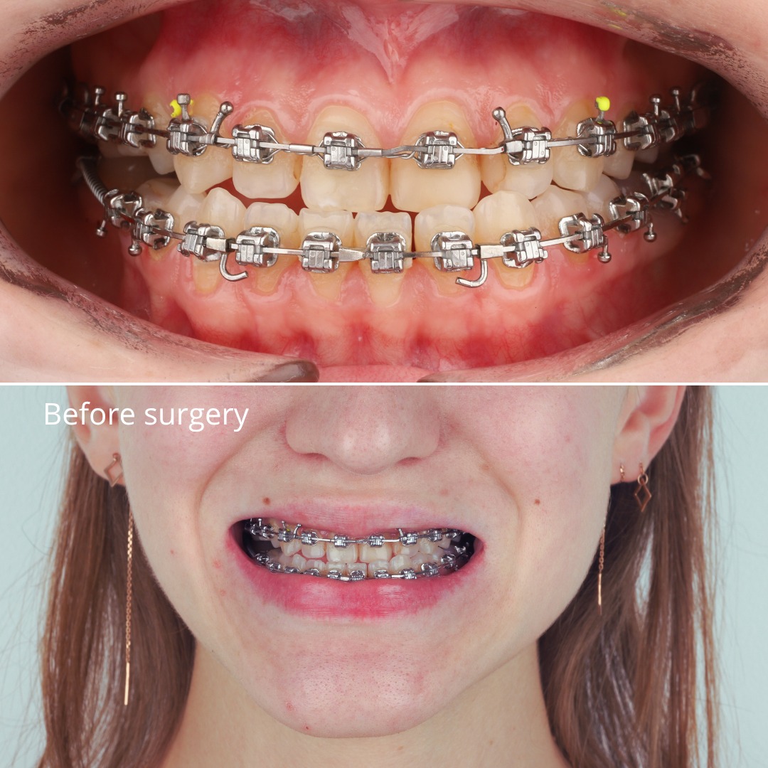 Stage showing the facial profile following surgical correction — photo 4 of 5