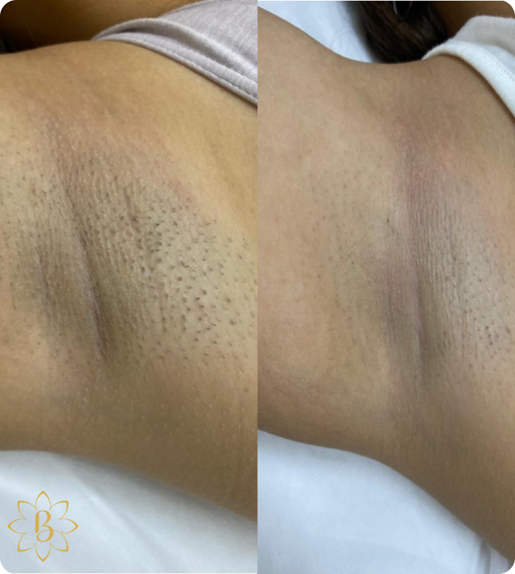 лазерная эпиляция рук