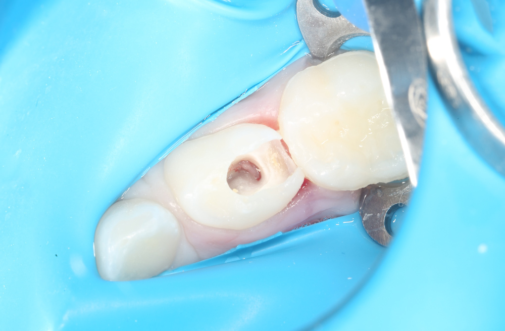 Как мы вылечили пульпит и сохранили молочный зуб у ребёнка 5 лет