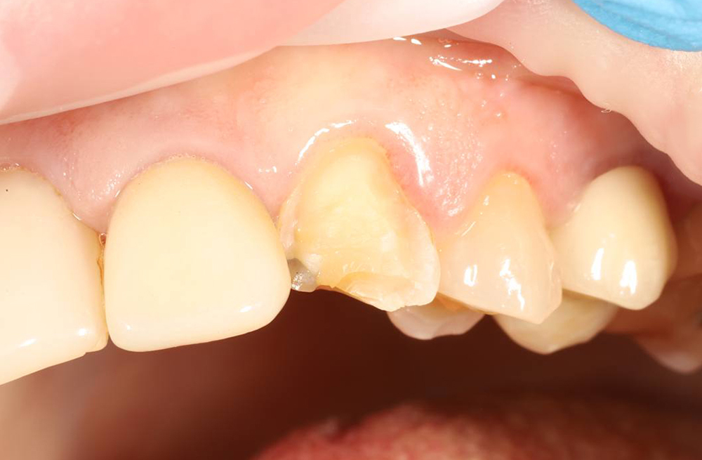 Воссоздание анатомии клыка после травматического скола методом художественной реставрации