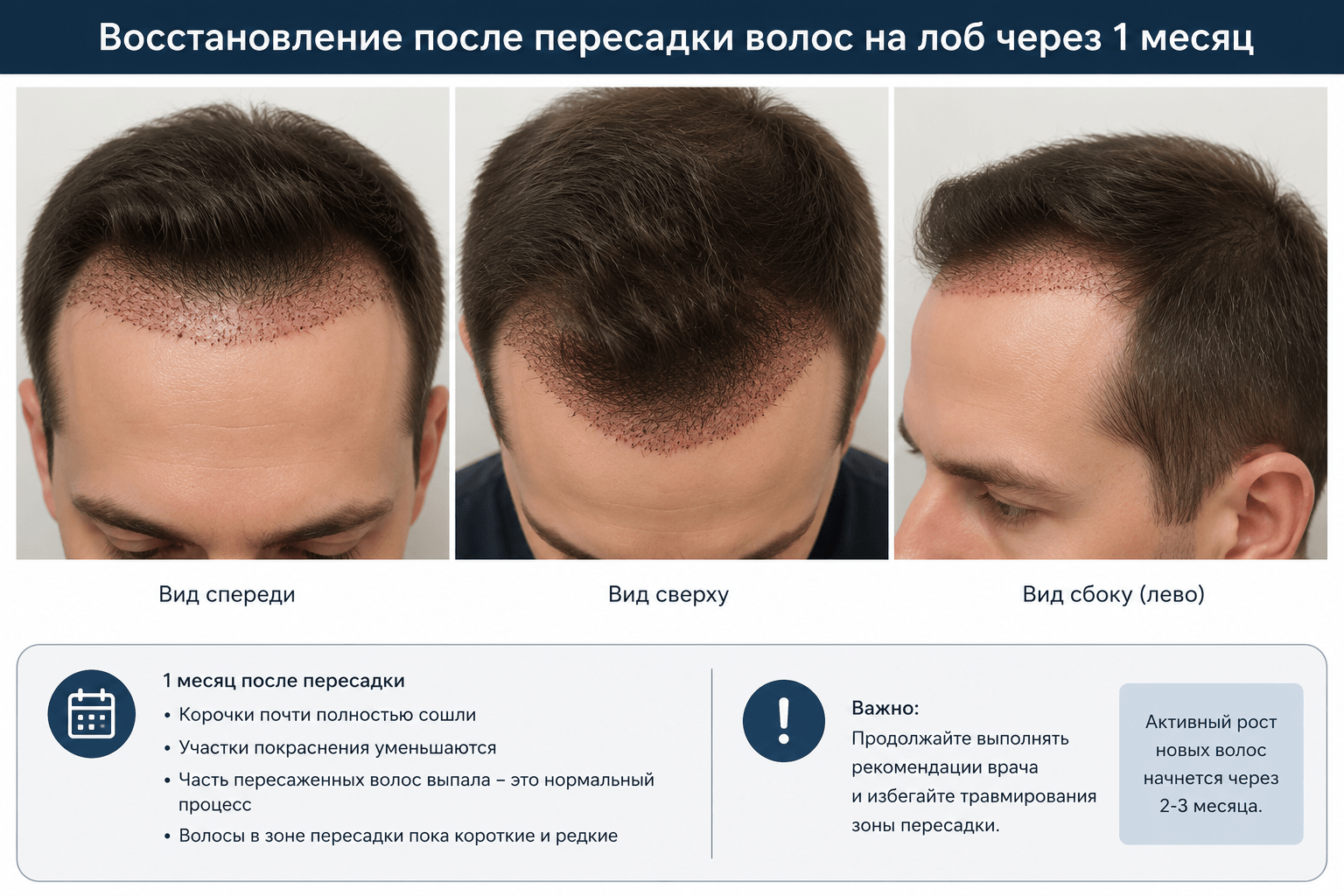 восстановление после пересадки волос на лоб первый месяц