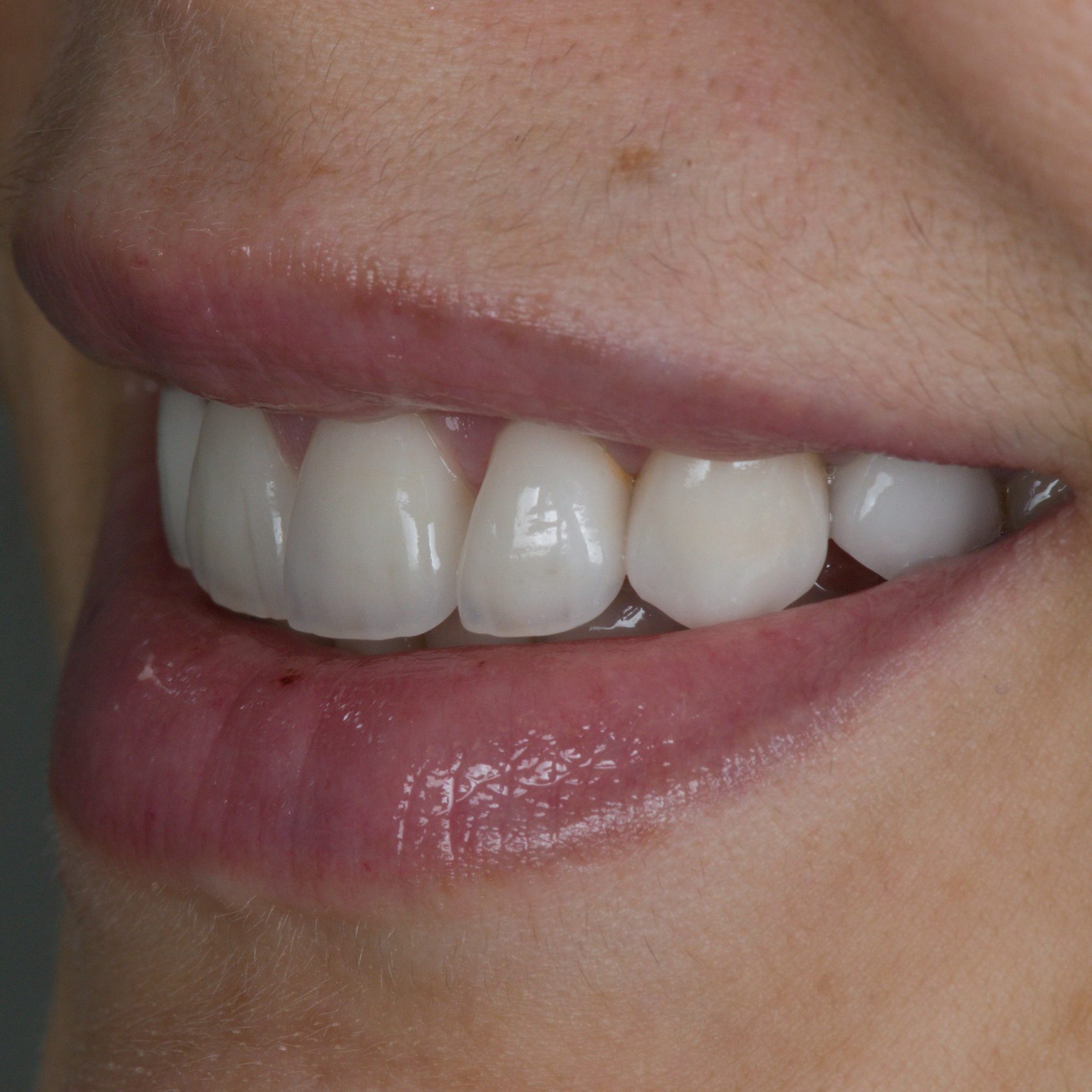 Трещина на верхних. Межзубный кариес на передних зубах. Кариес на передниз зуба.