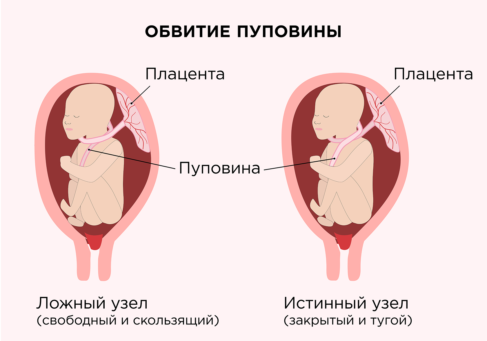 Отеки (водянка) во время беременности