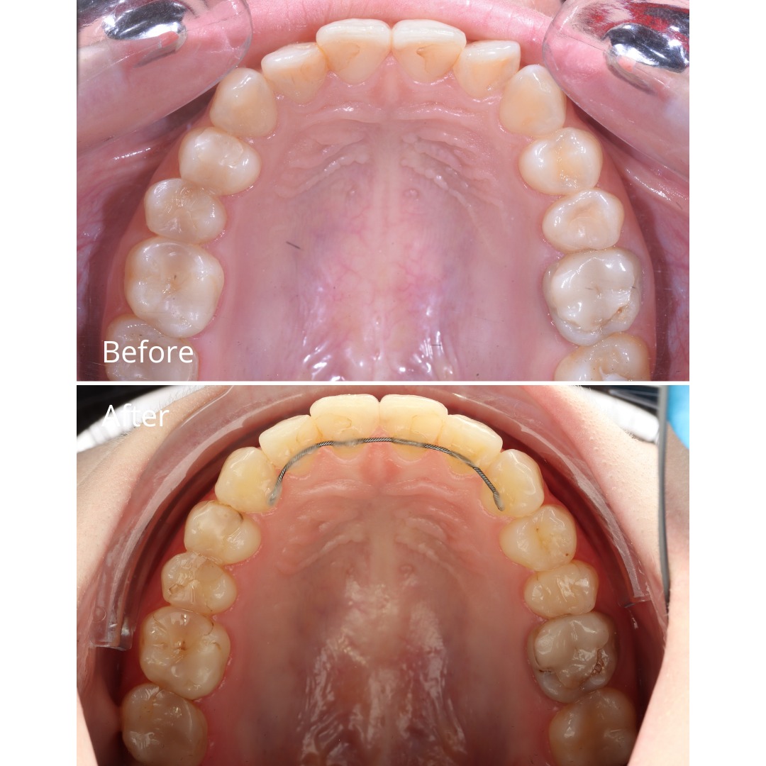 Stage photo documenting deep bite correction during treatment — photo 3 of 5