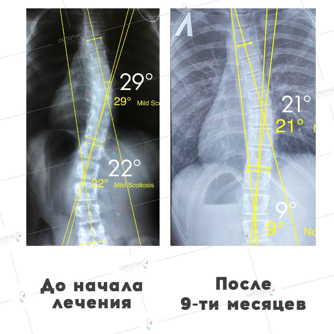 Тест на сколиоз. Th5=5 уровень сколиоз. Шох 2-3 период с5-с7,2 сколиоз шоп 2см. Сертификат FPA сколиоз.