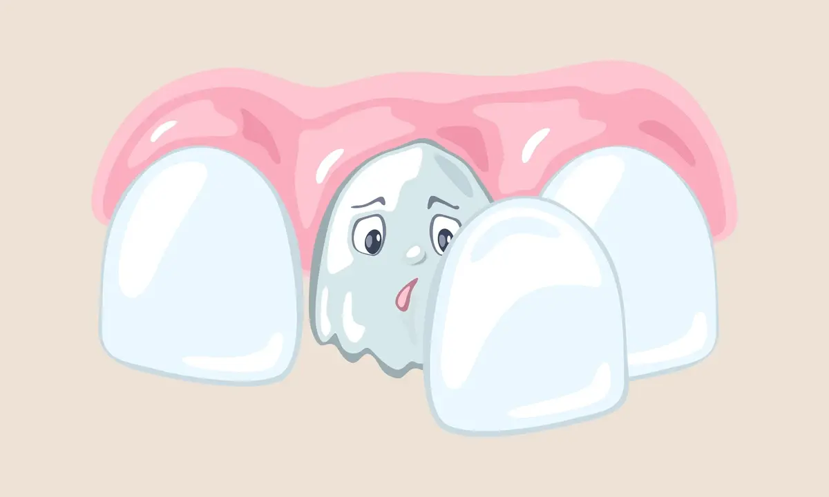 Виниры - Илюстрация