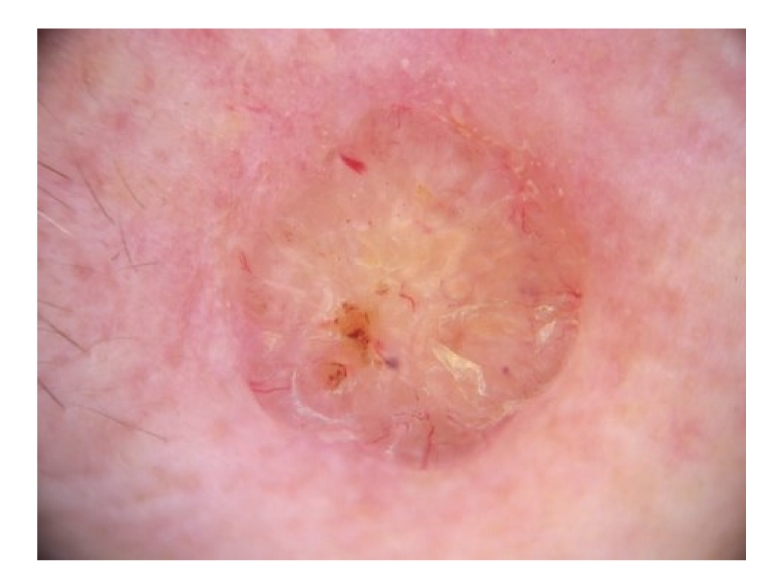 Дерматоскопические признаки цилиндром