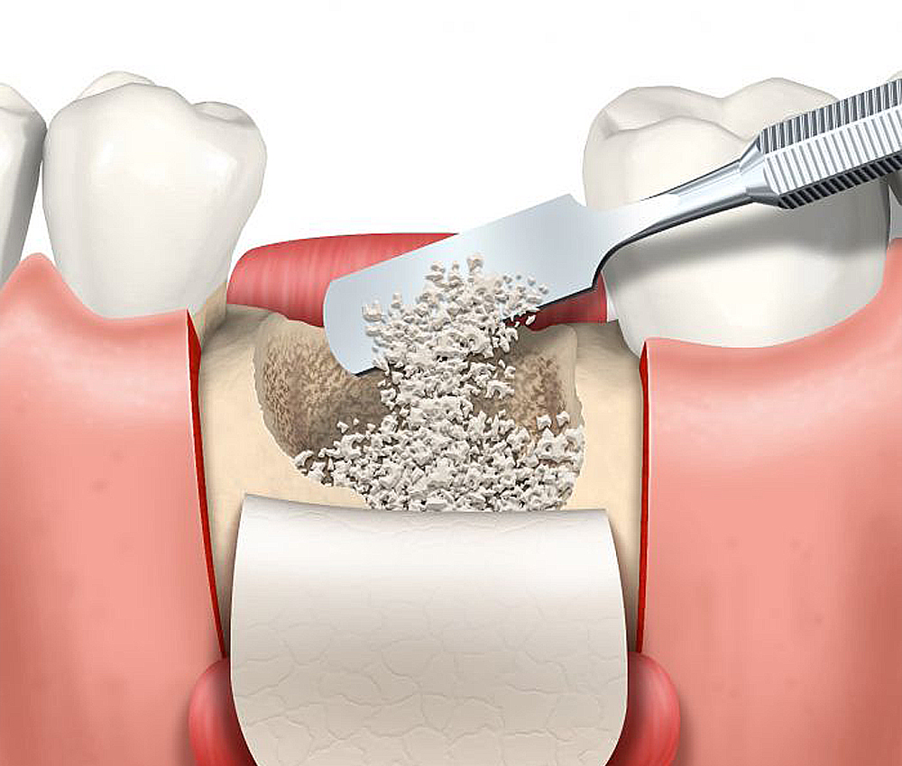 Костная пластика в стоматологии фото