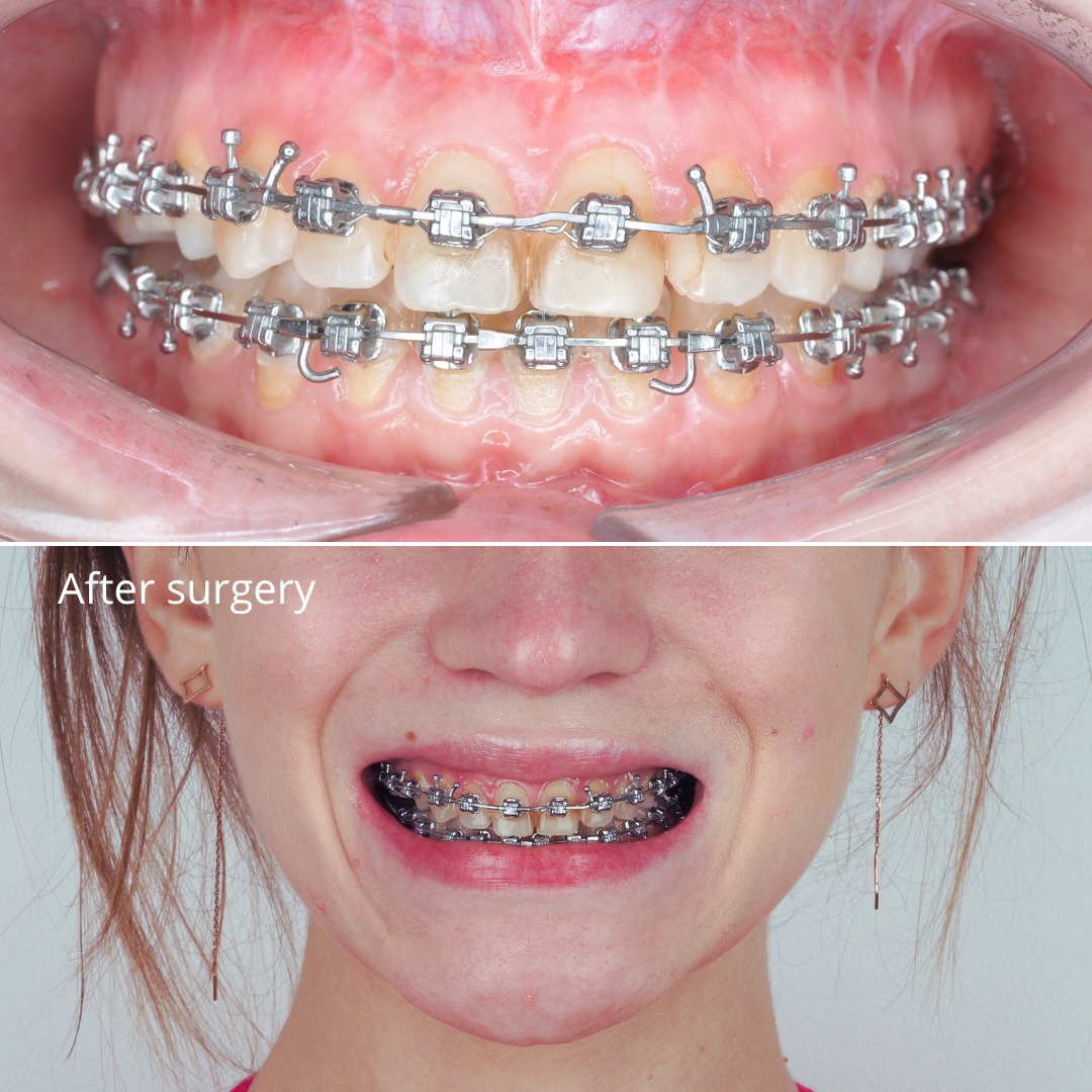 After treatment: symmetrical face and corrected bite following combined orthodontic-surgical treatment — photo 5 of 5