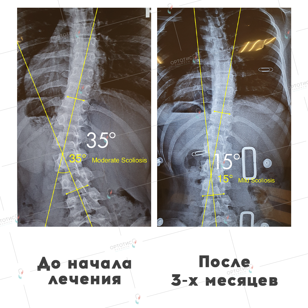 Тест на сколиоз. Шох 2-3 период с5-с7,2 сколиоз шоп 2см.