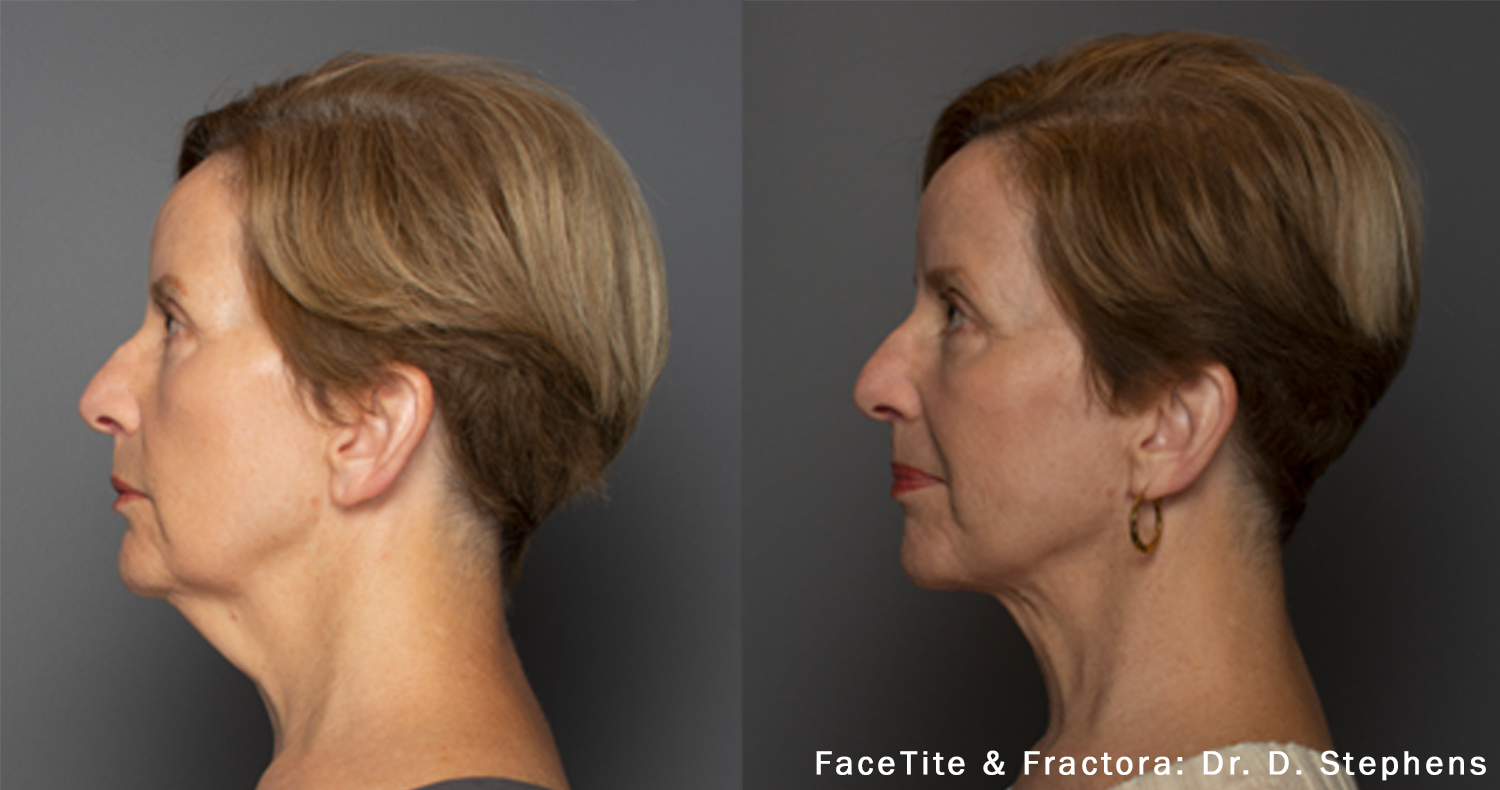 Пример до и после FaceTite и Fractora: нижняя треть лица