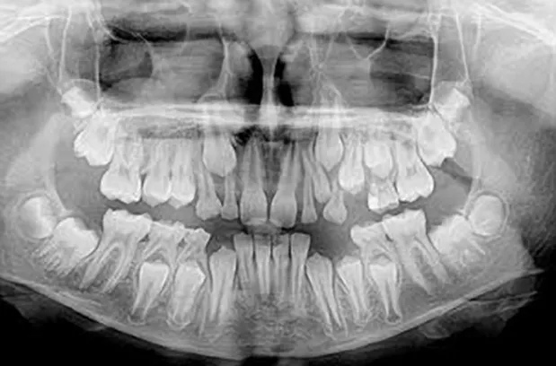 Рентген детских зубов фото