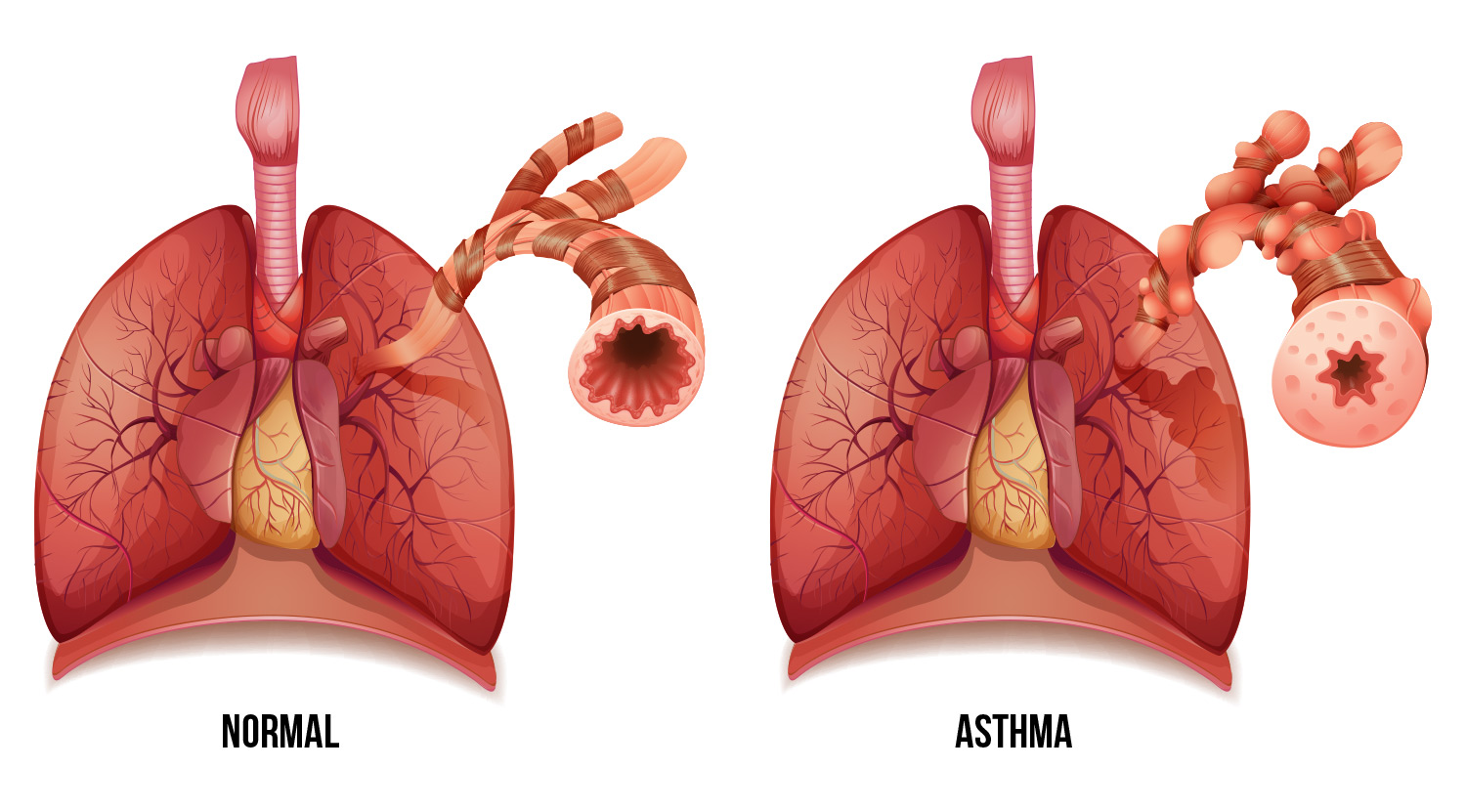 Бронхи при бронхиальной астме