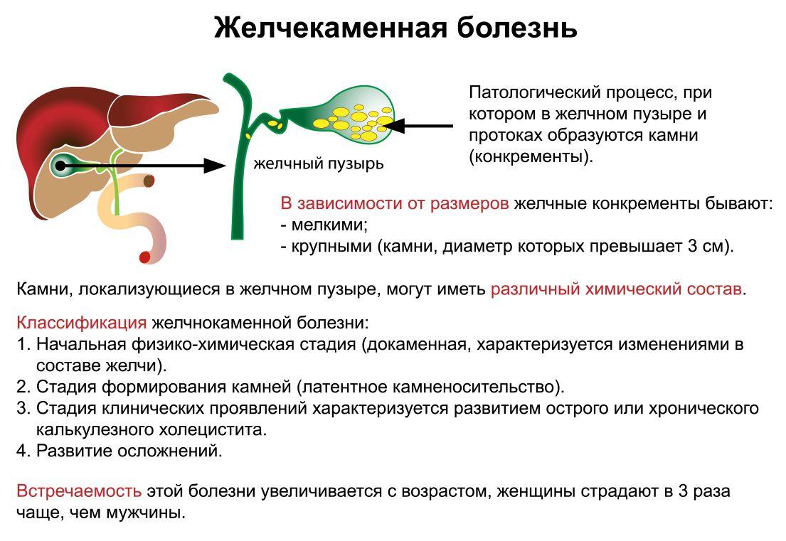 Печеночная колика наблюдается при тест аккредитация. Желчекаменная болезнь. Желчнокаменная болезнь. Образование камней в желчном пузыре. Желчекаменная болезнь симптомы.