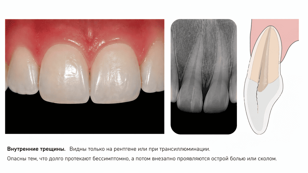 Внутренняя трещина переднего зуба