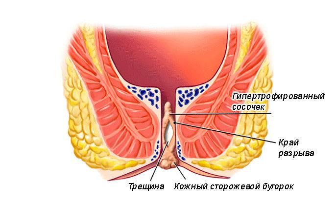 Папиллит заднего прохода: диагностика и лечение в Москве – «Алан Клиник»