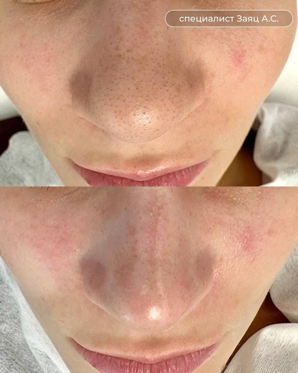 Hydrafacial - До и после