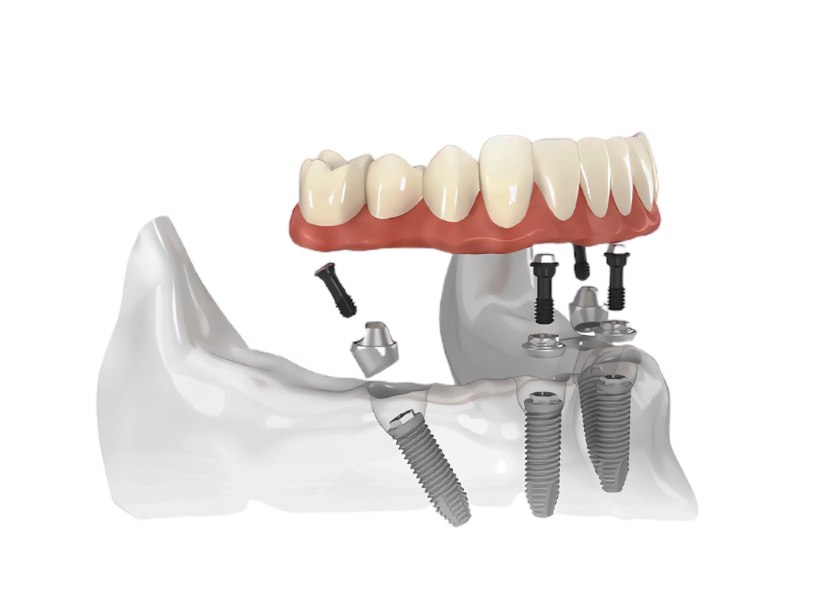 Имплантологическая кассета Nobel полный набор для all on 4. Зубные импланты Nobel Biocare. Имплантация зубов по технологии «all on 4».