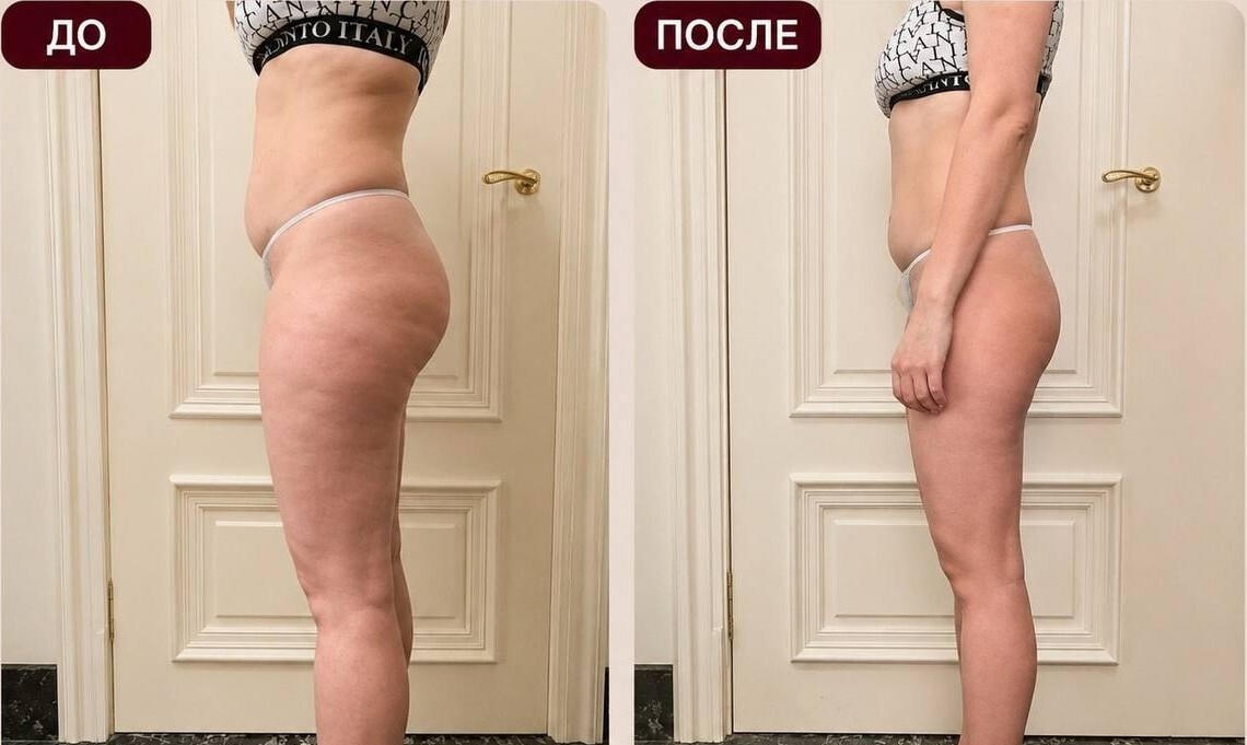 До и после 5 сеансов