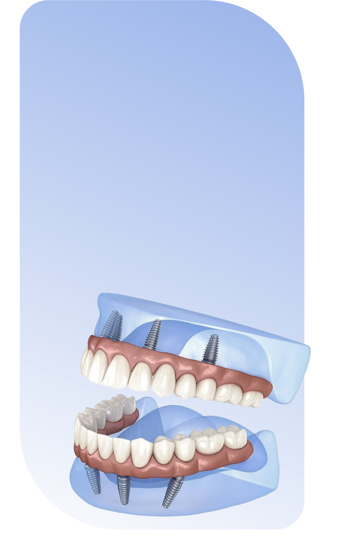 Имплантация и протезирование в Сургуте. Имплантация все на 6. All in 4, All in 6.