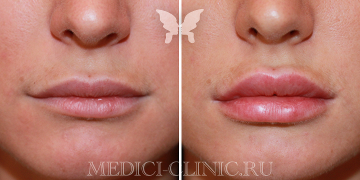 Фото до и после коррекции губ