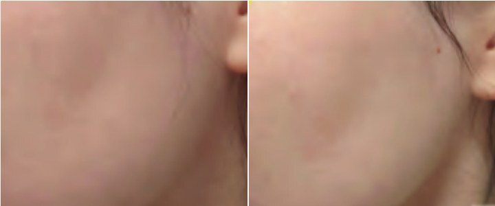 Кожа щеки до и после 4 недель с кремом PLONTE