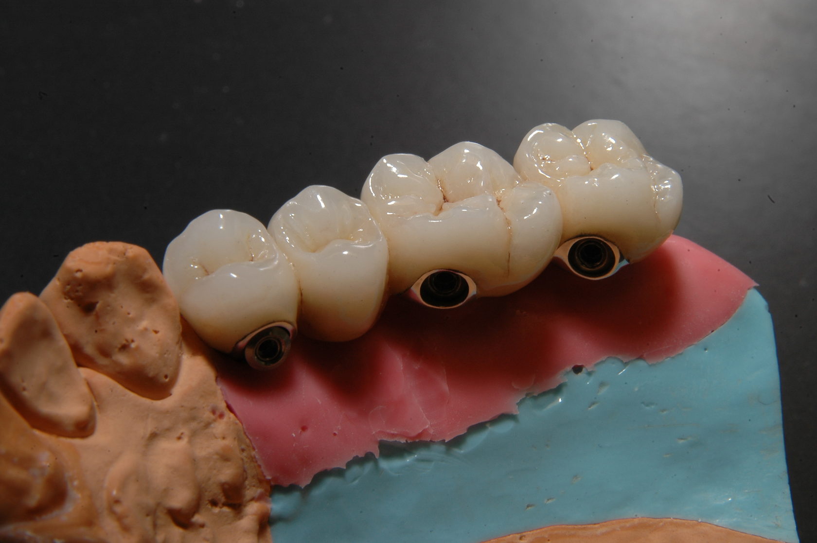 Зубной мост на крючках фото