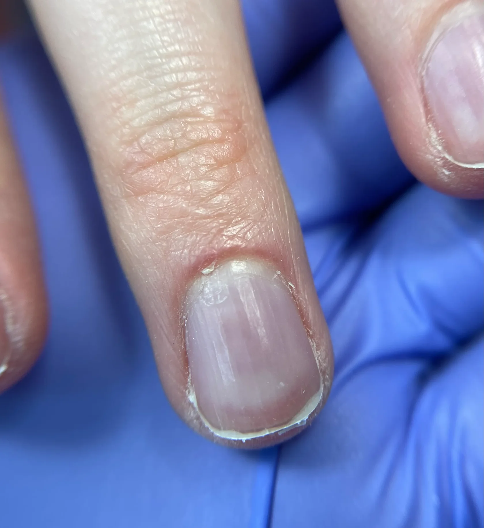 налипшая кутикула техника маникюра для работы с налипшей кутикулой без пропилов