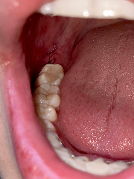 Альвеолит после удаления зуба: виды и лечение