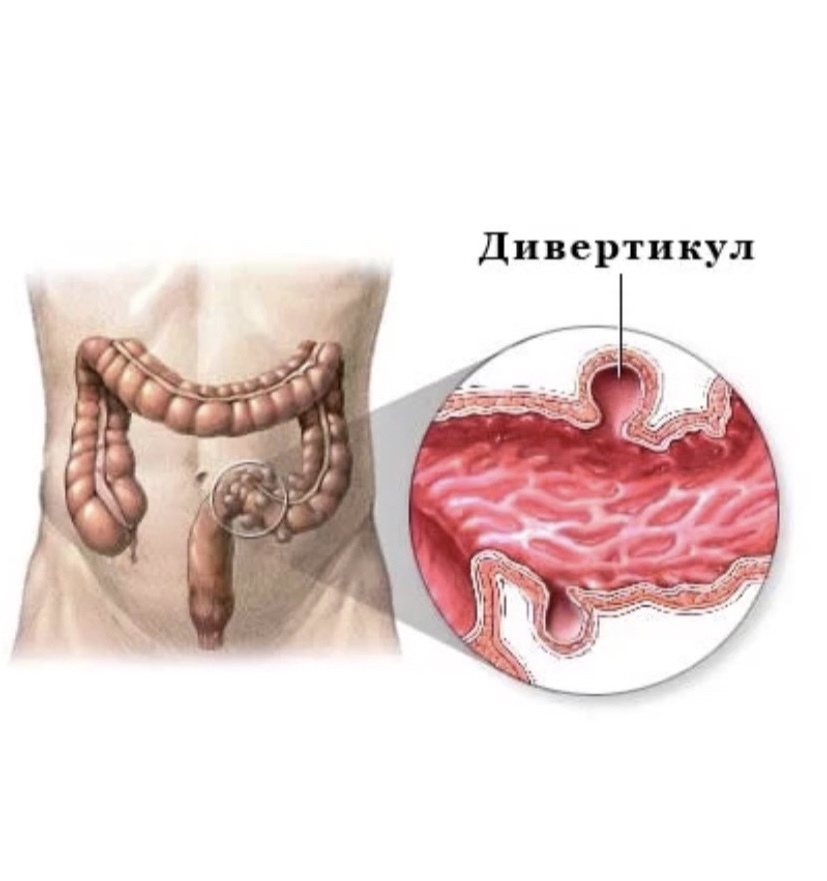 Дивертикул кишечника картинки