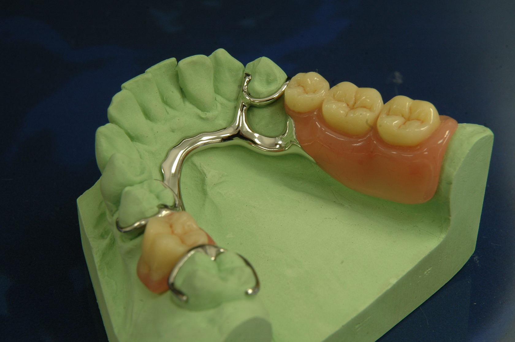 Поставить бюгельный протез. Бюгельный протез кламмерный (remanium-700). Мост зубной бюгельный протез. Бюгельный протез (2-3 кламмера). Бюгельный микропротез на 1 зуб.