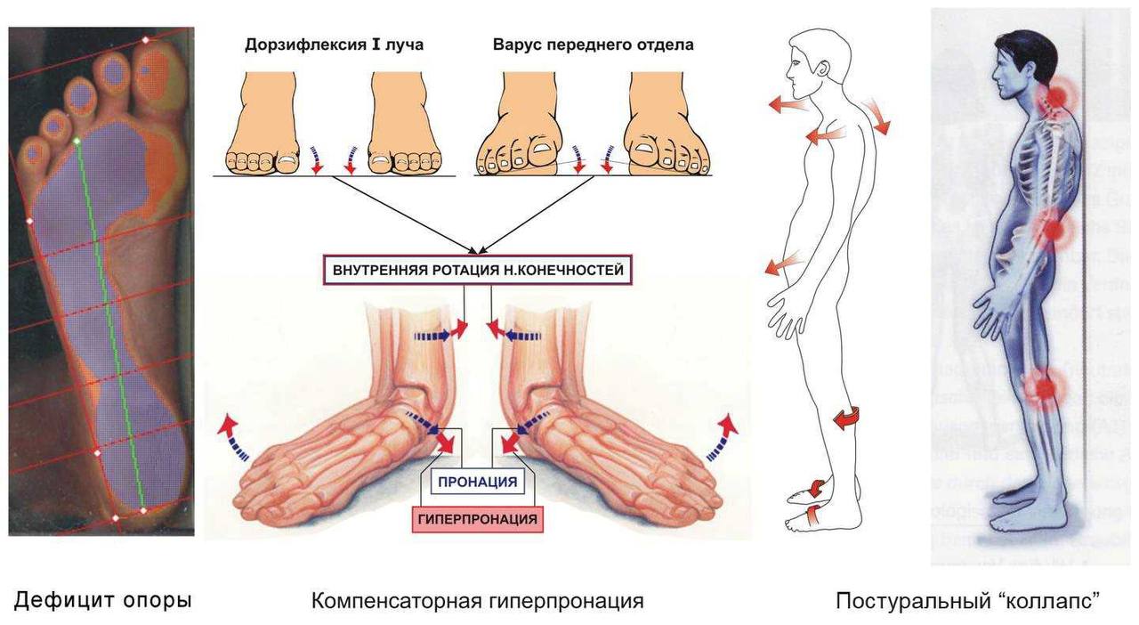 Схематично влияние состояния стопы на осанку