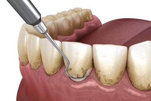 Снятие зубного камня ультразвуком