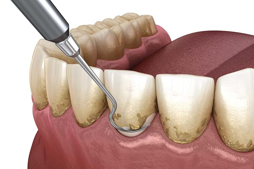 Удаляем зубной налет. 5 советов стоматолога