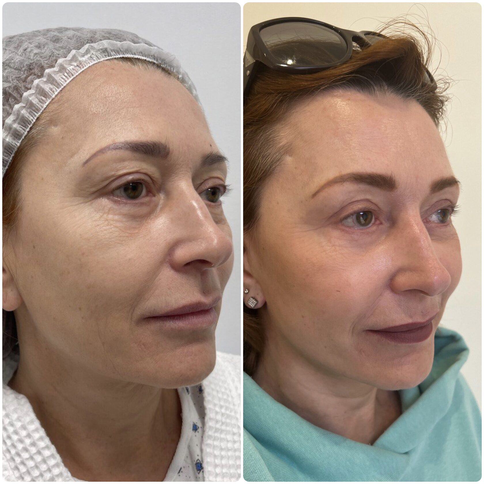 Подтяжка средней трети лица