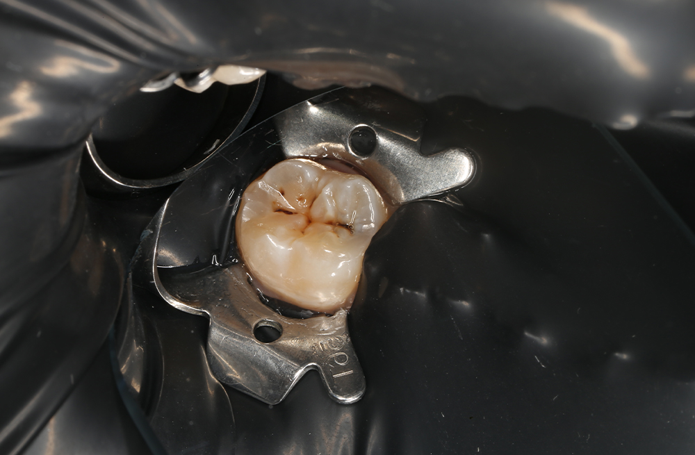 Лечение кариеса дентина композитным материалом Harmonize A3,5