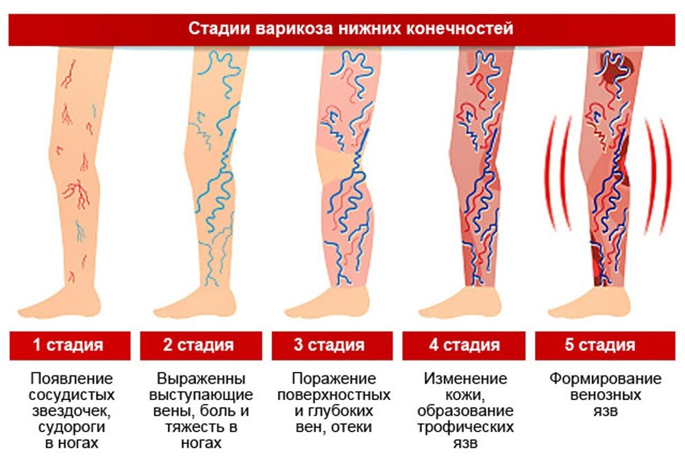 Варикозное расширение вен нижних конечностей карта вызова смп шпаргалка