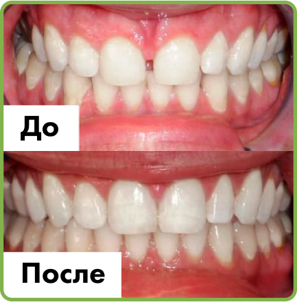 Установка имплантов в Дербенте. Имплантация при отсутствии одного зуба.