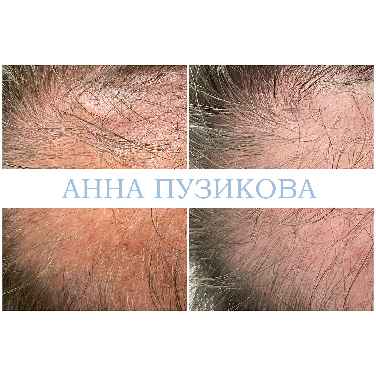 Результат лечения выпадения волос: повышение густоты, укрепление корней и улучшение состояния кожи головы — Прадус СПб.