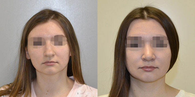 Ринопластика клиники. Траумель после ринопластики.