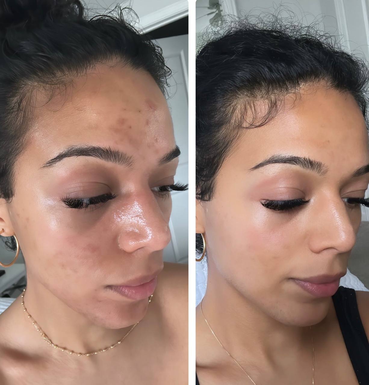 Before and after — post-acne hyperpigmentation improving after Red Carpet Facial treatment series at Beauty Studio by Hanna, Mount Pleasant SC