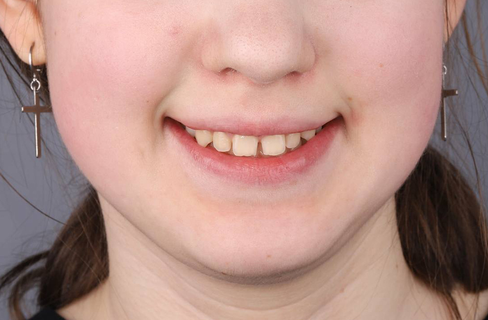 Лечение глубокого травматического прикуса с применением гнатологической подготовки и брекетов