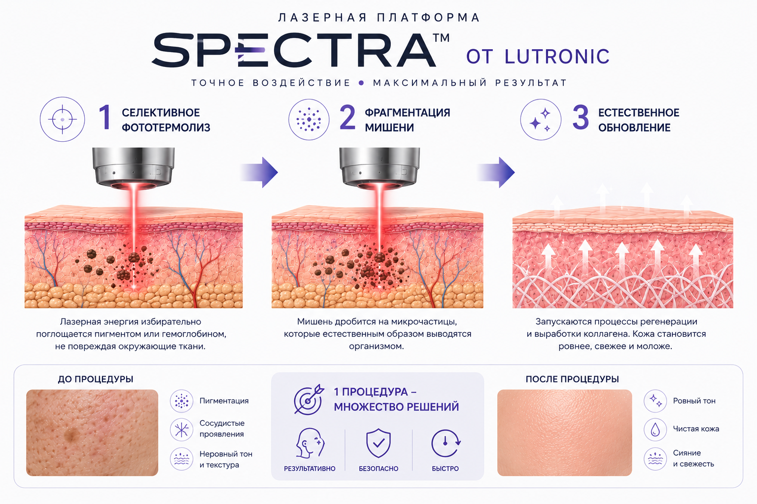Lutronic Spectra XT: схема воздействия на пигмент