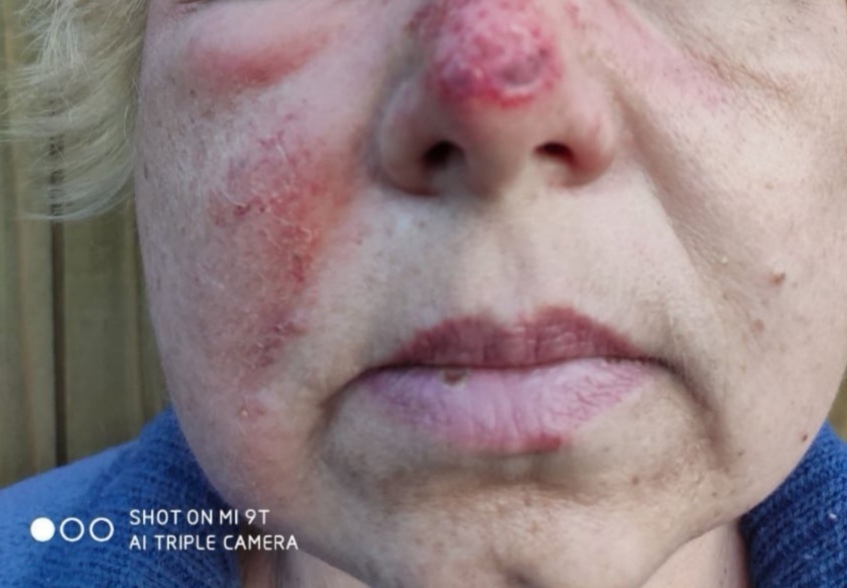 Практика лечения рожистого воспаления вытяжками Солодовниковой