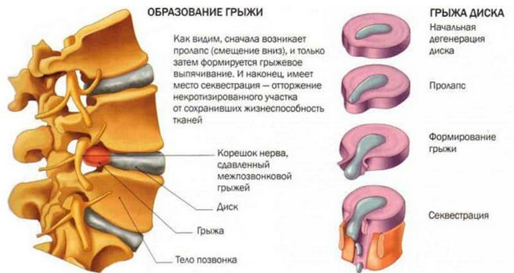 Схема лечения грыжи позвоночника