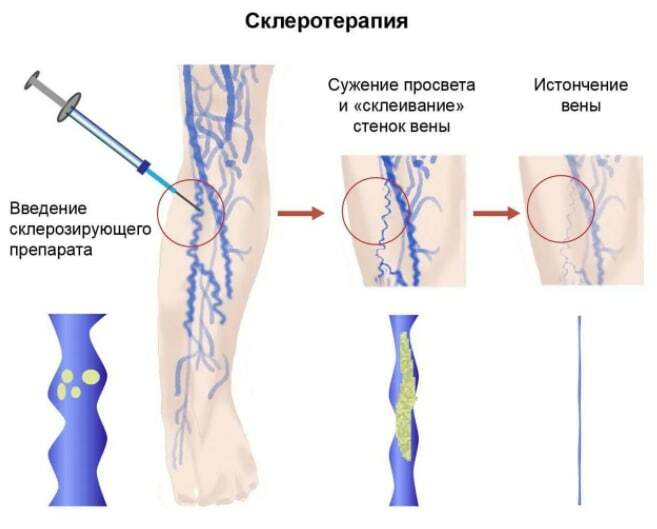 Синяки без причины: почему лопаются сосуды на теле