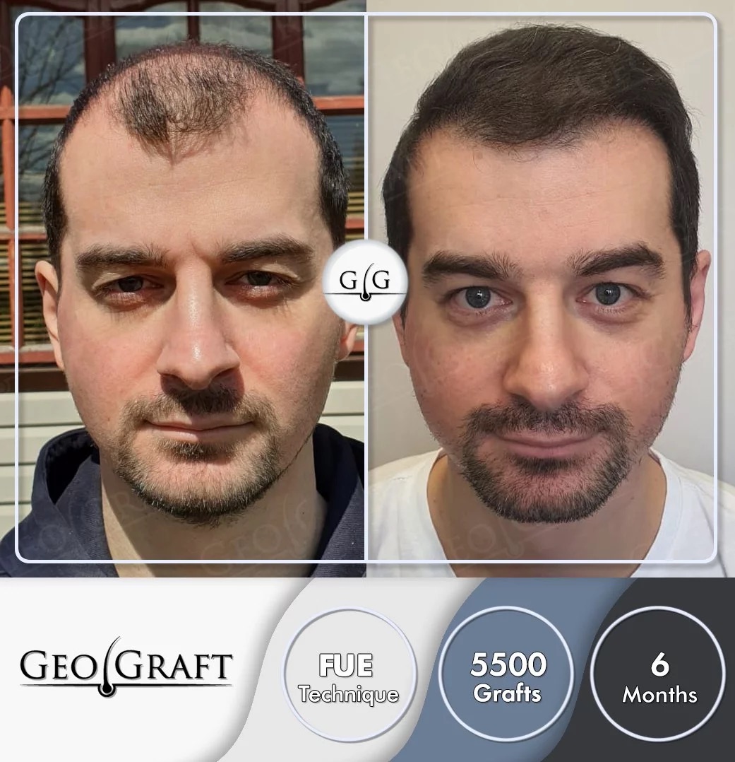 Пересадка волос в Москве. Geograft. Без боли - за один день.
