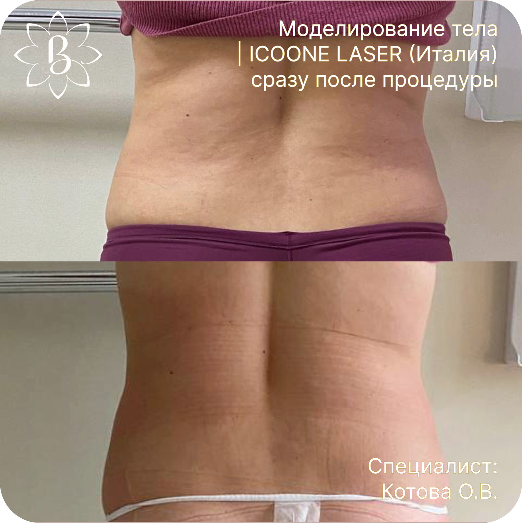 Диодная лазерная эпиляция