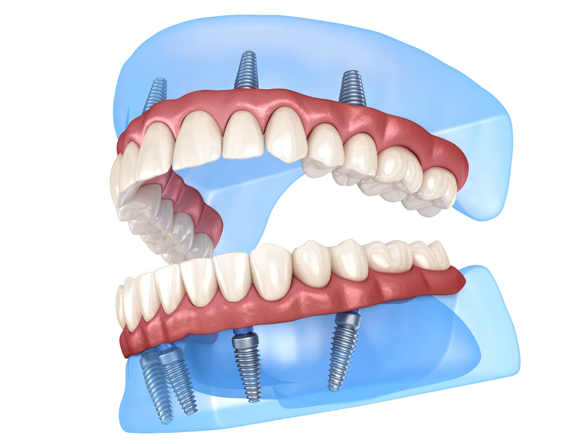 Имплантация зубов all on 6. Одноэтапная имплантация all-on-4. Имплантация челюсти на 6 имплантах.