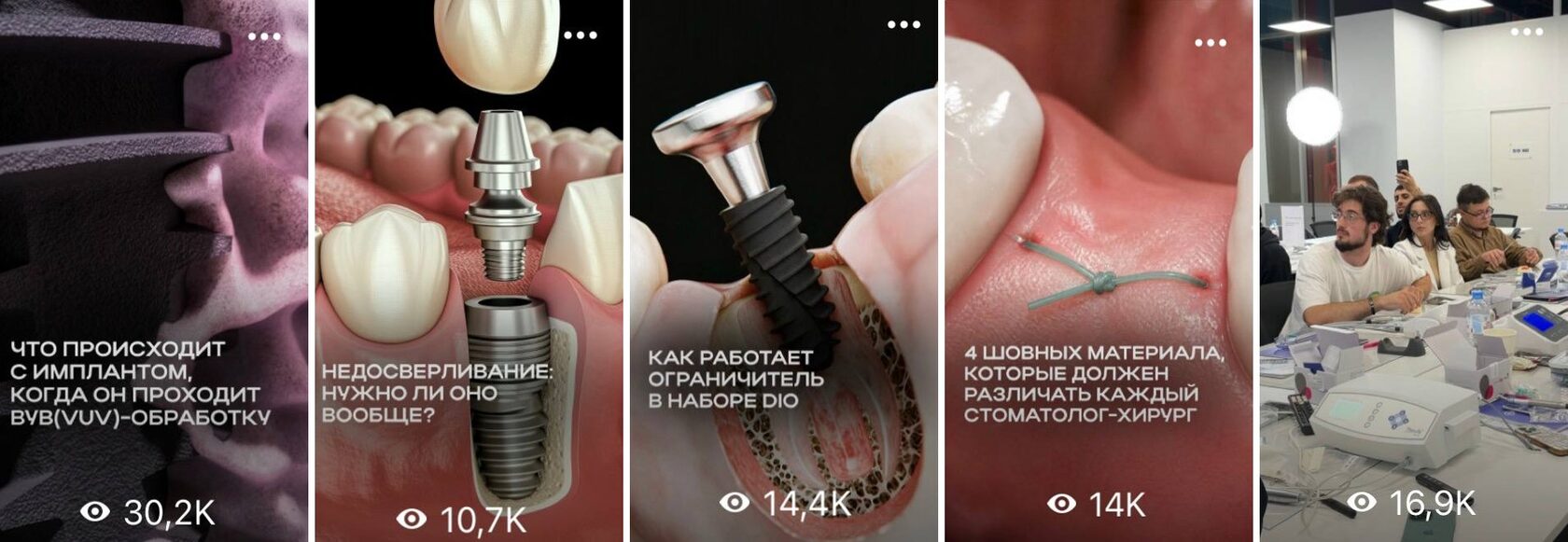 DIO Implant